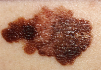 A melanoma skin cancer