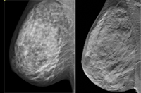 2D mammography vs digital breast tomography