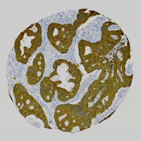 Bowel cancer cells