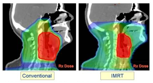 Intensity Modulated Radiotherapy