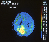 A PET scan of a brain tumour