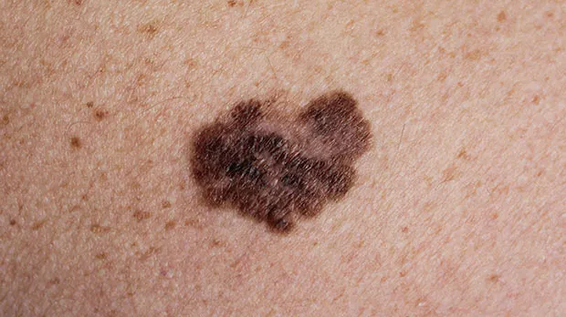 Melanoma skin cancer