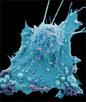 An emectron micrograph of a breast cancer cell, courtesy of the Cancer Research UK EM lab, London Research Institute
