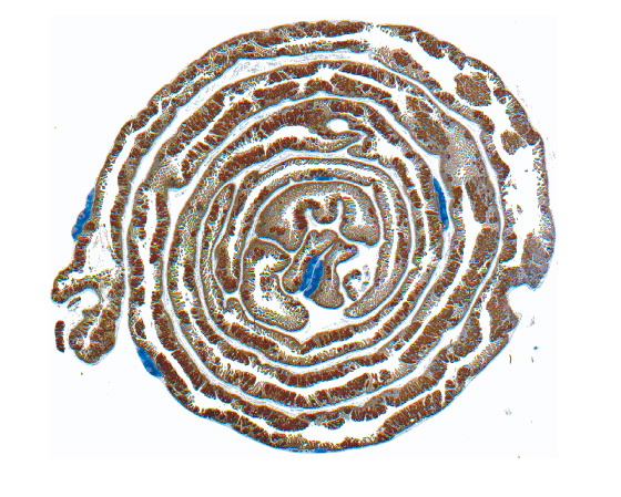 Bowel tissue, showing tumours developing Bowel tissue, showing tumours developing