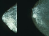 Claims of a breast cancer cure in 2 years are misleading