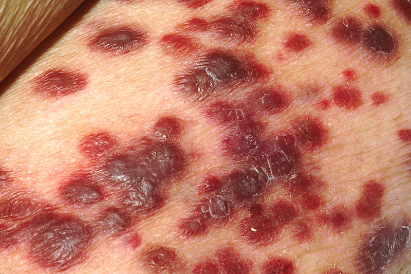 800px-Kaposi's_Sarcoma