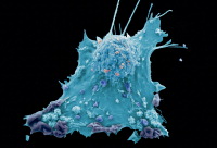 Breast cancer cell