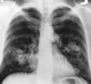 A chest X-ray showing lung cancer