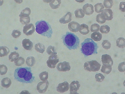 Hairy-cell leukaemia