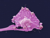 Breast cancer cell (credit: LRI EM Unit)