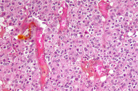 Oligodendroma cells