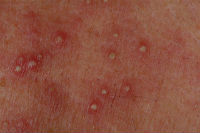 acneiform rash
