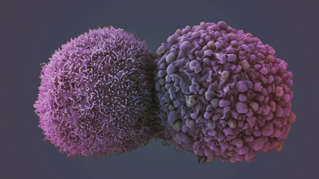 Lung cancer cell (image courtesy of the London Research Institute EM unit)
