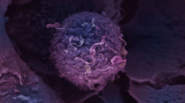 An electron microscopy image of a breast cancer cell