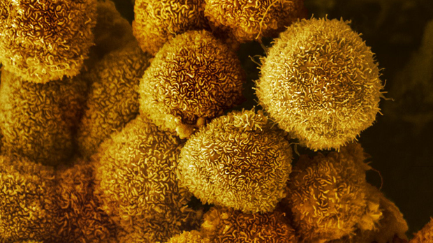 Microscope image of pancreatic cancer cells