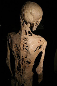 FOP traps patients in a second skeleton as they age