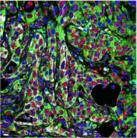 Pancreatic cancer cells with lots of fascin (green) - image provided by the researchers