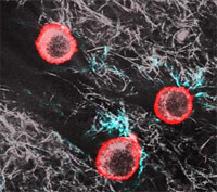 Round melanoma cells (red) dissolve the grey collagen matrix