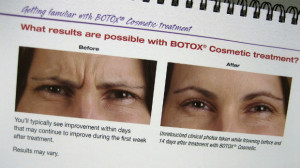 Botox advet