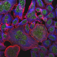 These cancer cells carry an incorrect number of chromosomes in each nucleus – a condition known as ‘aneuploidy’. The green spots show a marker for the chromosomes, and the red and blue fluorescent stains highlight two different parts of the cell’s internal skeleton.