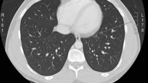 Lung CT scan