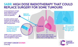 SABR: radiotherapy that's smart, fast and to the point - Cancer ...