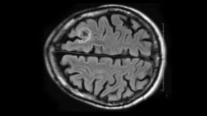 An image of an MRI scan of a brain with the glioblastoma tumour in white.