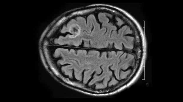 An image of an MRI scan of a brain with the glioblastoma tumour in white.