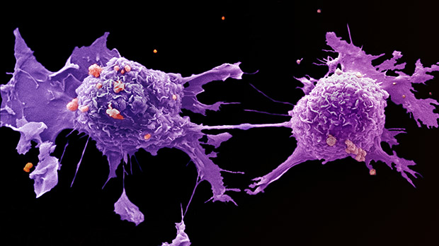 Image of lung cancer cells under a microscope.
