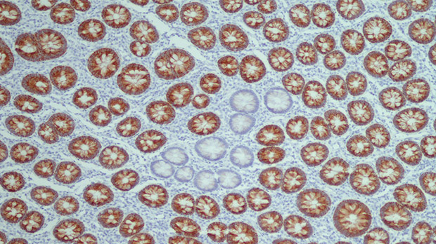 Section of human colon stained for a protein called MAOA (shown in brown). The blue crypts carry a fault in the MAOA gene, which stops the protein being made and means the crypt no longer shows up as brown. We think the fault appears in one crypt which then divides again and again (in a process called "fission") to form patches of mutant crypts.