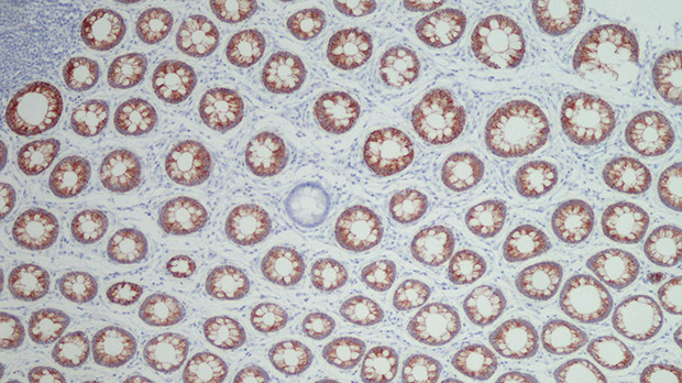Section of human colon stained for a protein called MAOA (shown in brown). The blue crypt carries a fault in the MAOA gene, which stops the protein being made and means the crypt no longer shows up as brown. With this method we can follow the spread of mutations without looking at the cells' DNA.