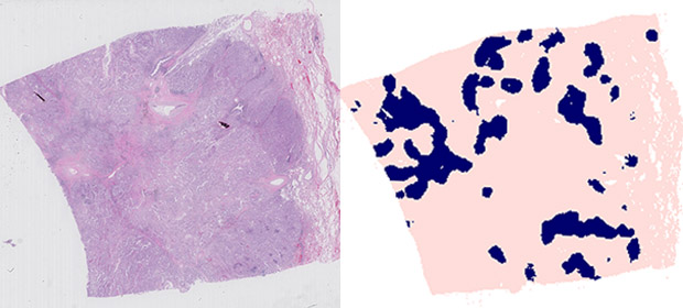 A lung biopsy sample with immune 'hotspots' highlighted 
