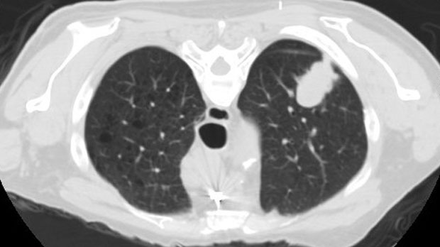 Lung cancer CT scan