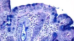 Barrett's oesophagus tissue sample