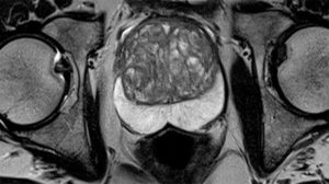 A specialist prostate MRI scan, called multiparametric MRI