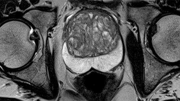 does prostatitis show up on mri)