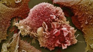 Lung cancer cell image.