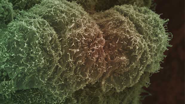 Prostate cancer cell