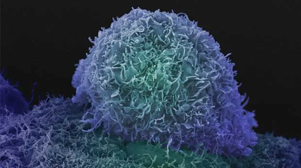 Prostate cancer cell