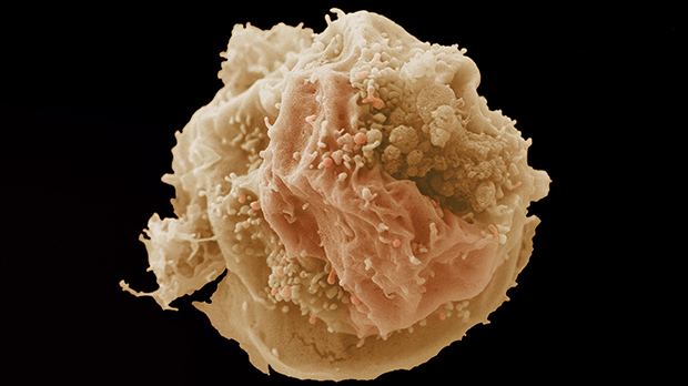 Breast cancer cell image (credit: LRI EM department)