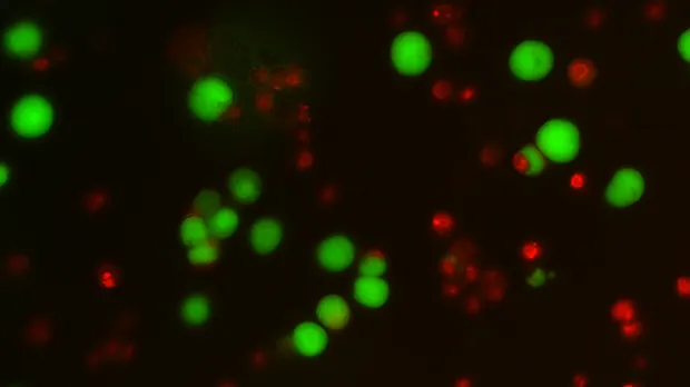 Alive (green) and dead (red) myeloma cells under the microscope.