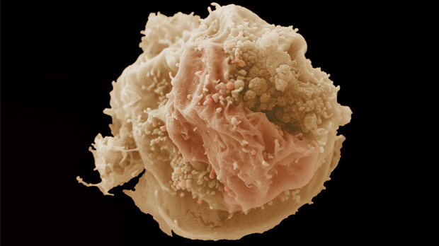 A photograph of a breast cancer cell under a microscope
