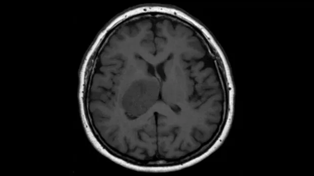 A brain tumour on a scan