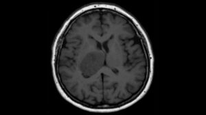 A brain tumour on a scan