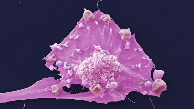 A photograph of a breast cancer cell under a microscope