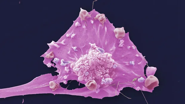 A breast cancer cell seen under the microscope