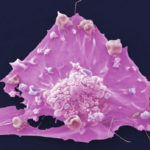 Breast cancer cell seen through a scanning electron microscope