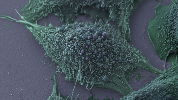 Lung cancer cells under the microscope