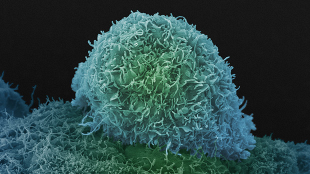 A prostate cancer cell.