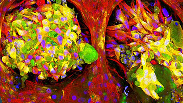 Lung cancer cells (green) grow within healthy lung tissue (red)